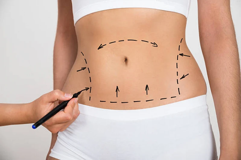 cirurgia de abdominoplastia
