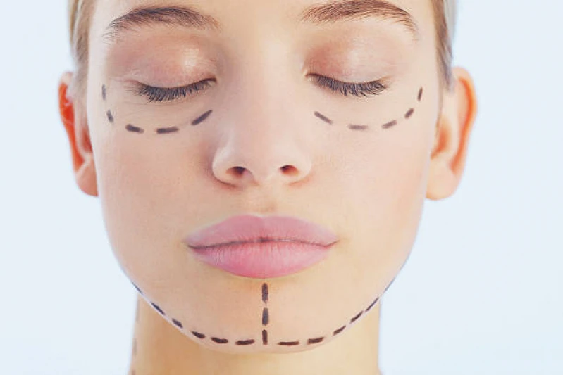 cirurgia de blefaroplastia