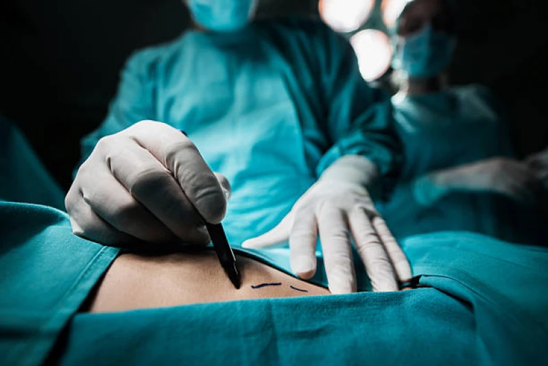 cirurgia de ginecomastia