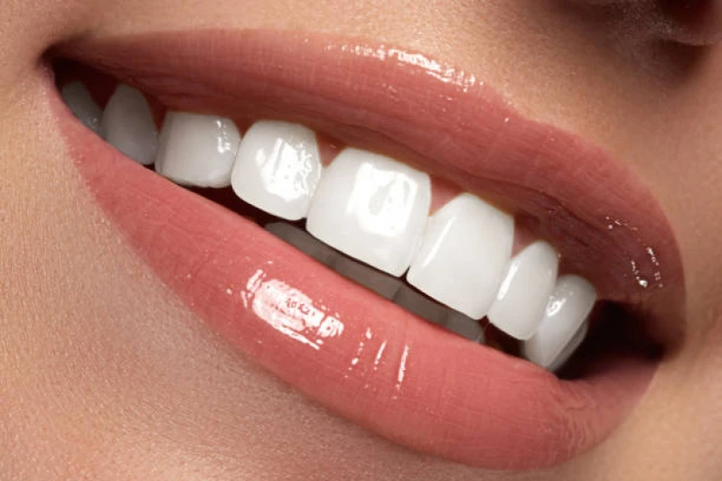 faceta de porcelana em apenas um dente