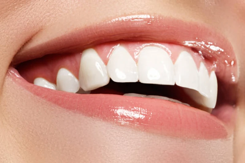 faceta nos dentes da frente