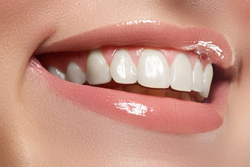 facetas de porcelana ipiranga