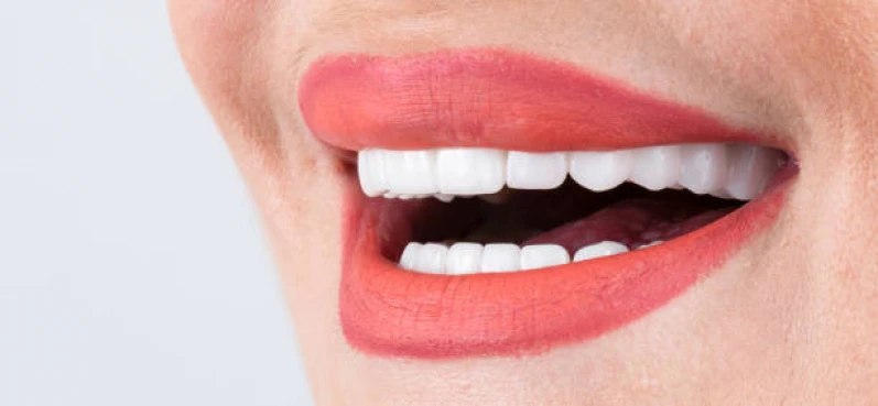 facetas de porcelana para os dentes