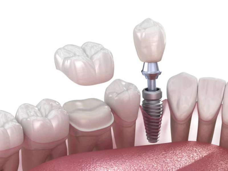 implante dentario com enxerto