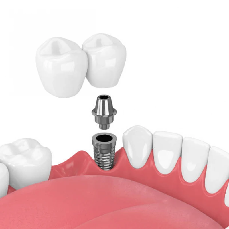 implante dentário fixo