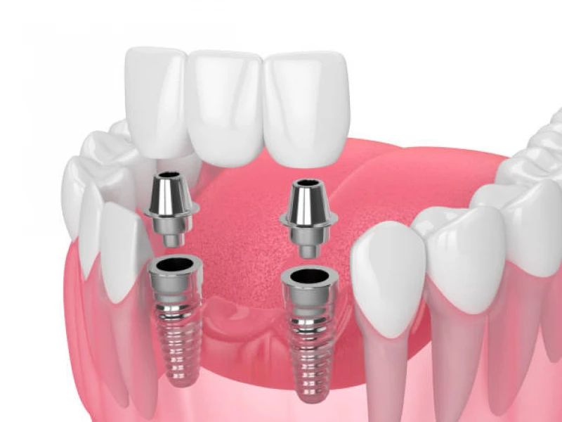 implante dentário inferior