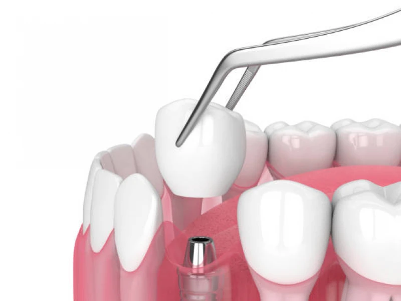 implante dentário cambuci