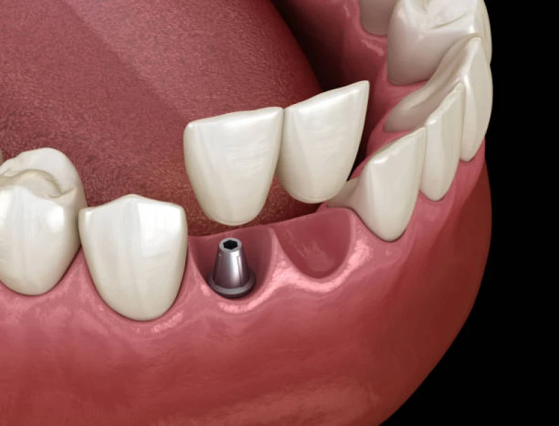 implante dentario na frente