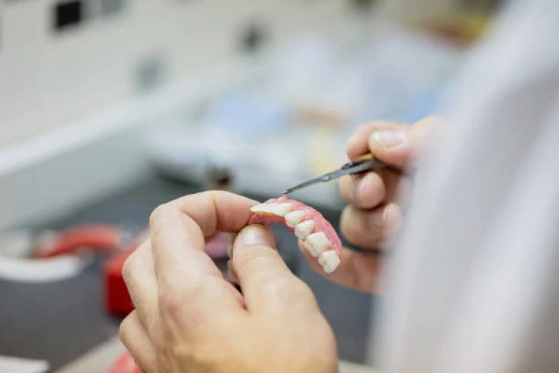 implante dentário todos os dentes