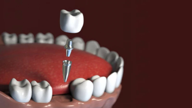 implantes dentais