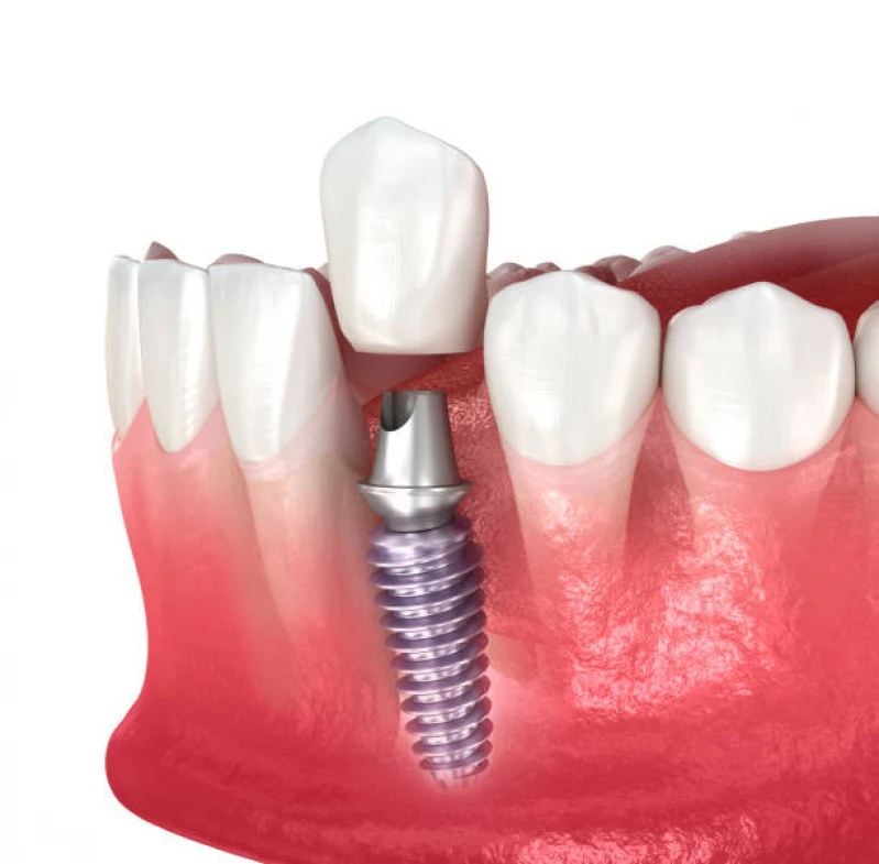 implantes dentários