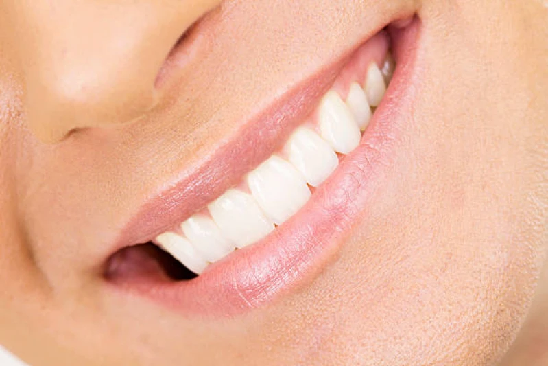 lente de contato dental natural
