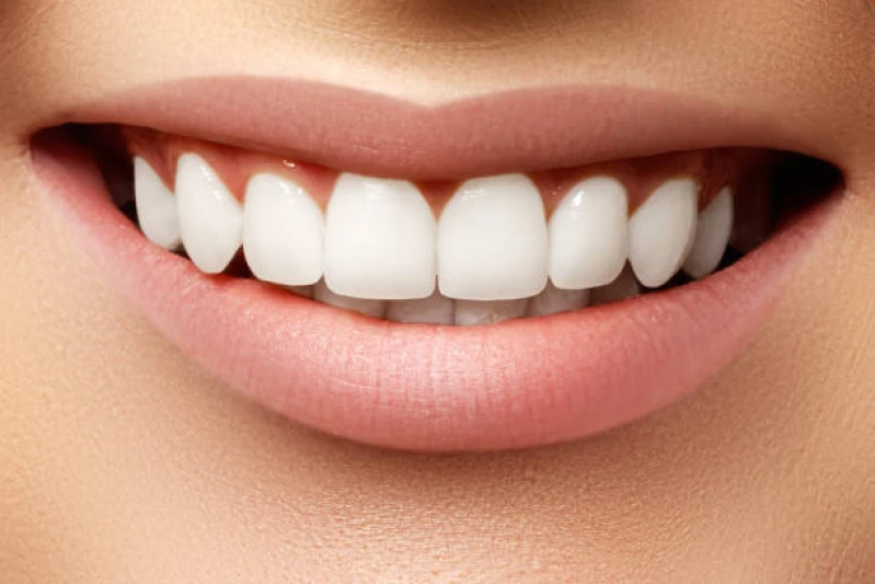 lente de contato dental ipiranga