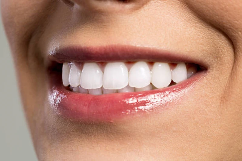 lente de porcelana no dente