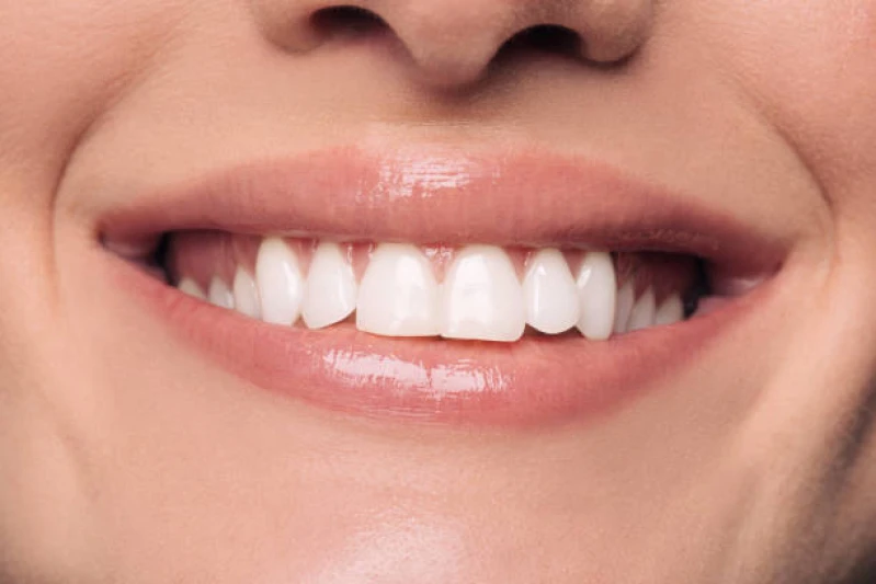 lente para os dentes